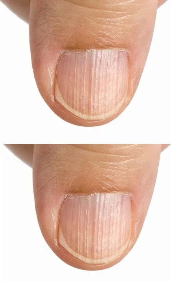 What It Means If You Have Ridges On Your Fingernails