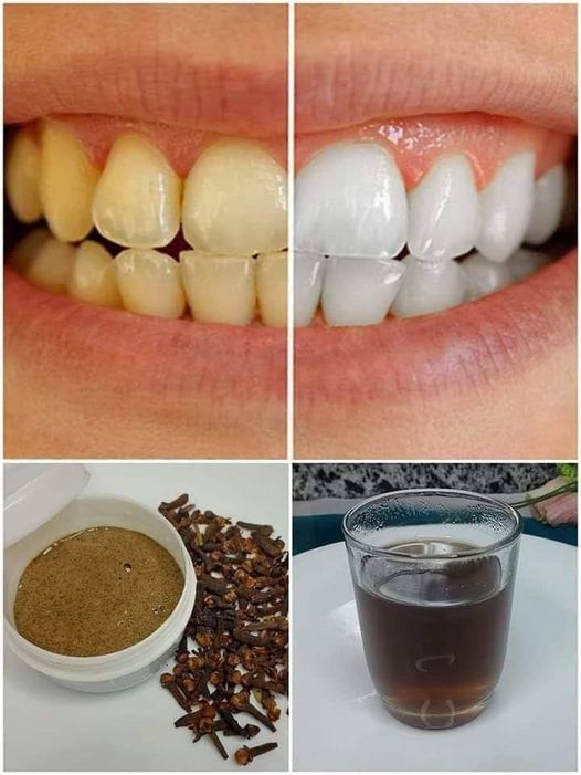 Teeth whitening: 7 proven recipes that remove yellowing permanently