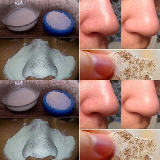 How to remove blackheads naturally