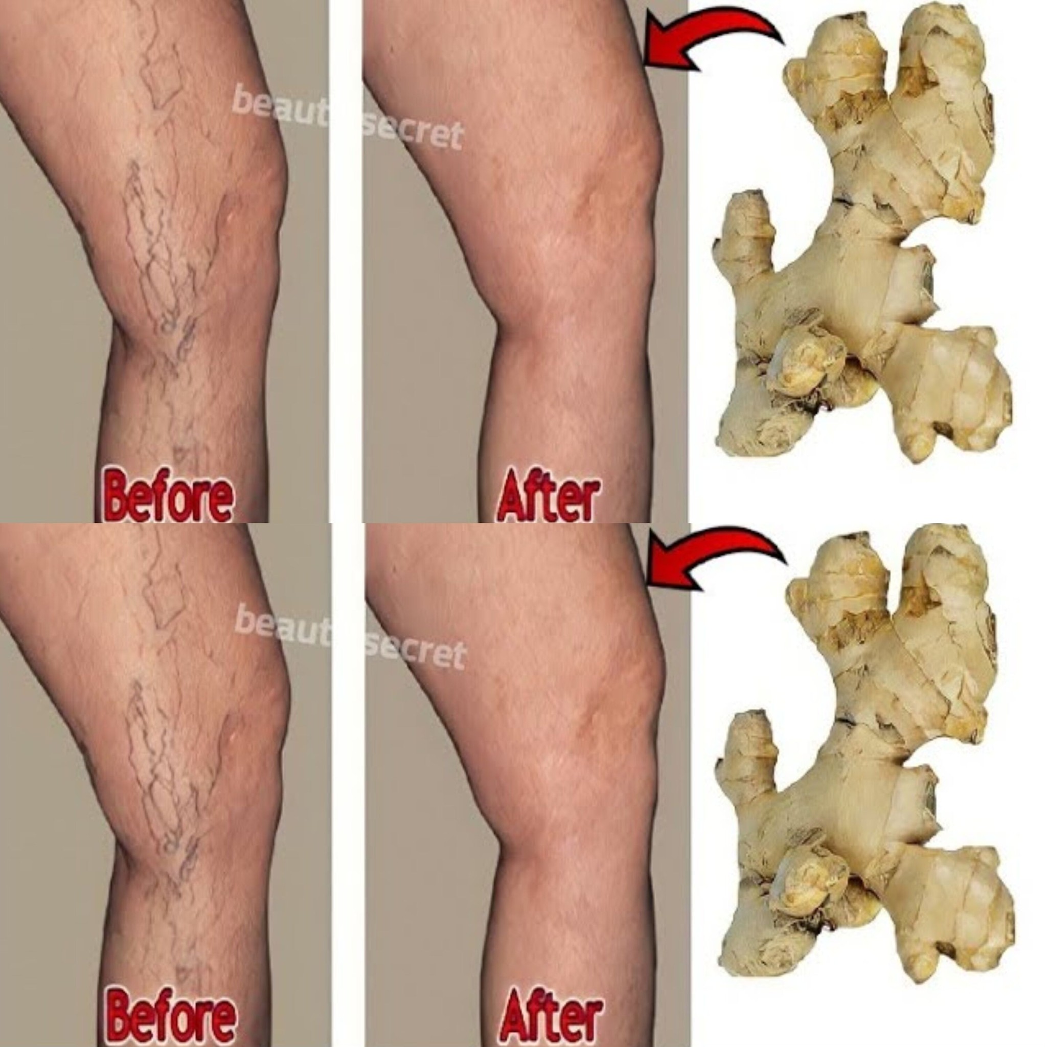 Say goodbye to varicose veins and joint pain with only 2 natural ingredients