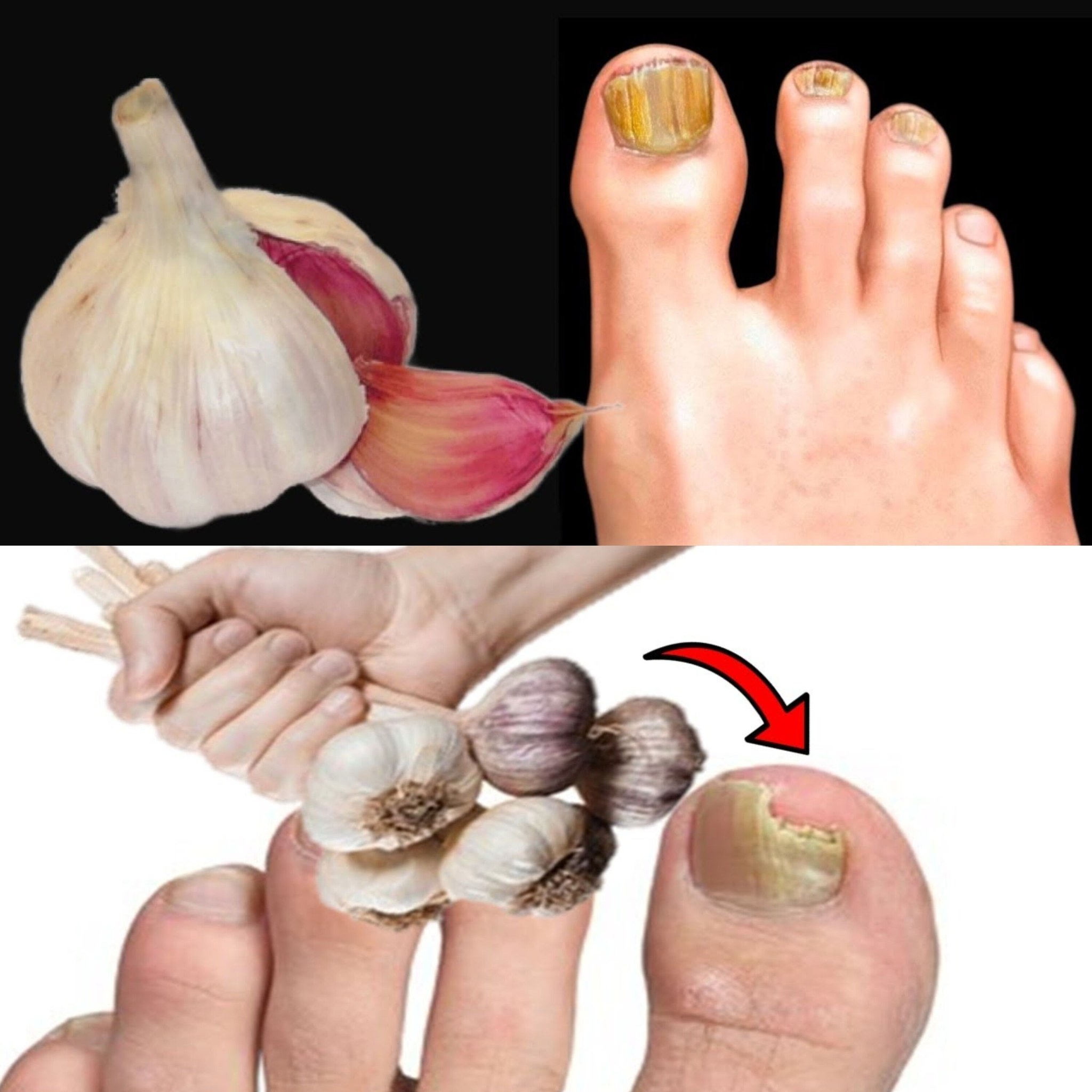 Instantly removes nail fungus like an eraser! The best natural remedy! Efficiency