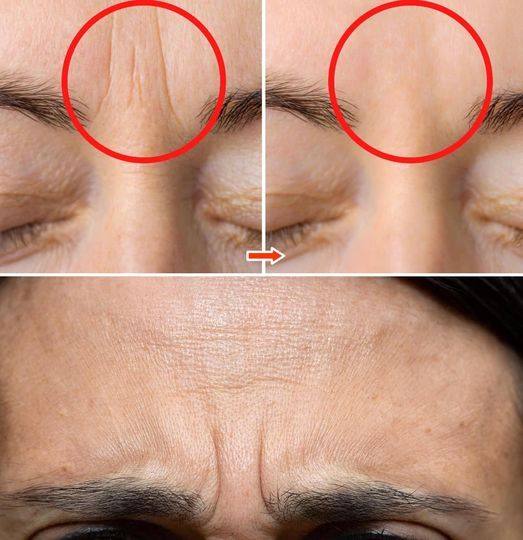 The 3 most effective tips to reduce wrinkles between the eyebrows