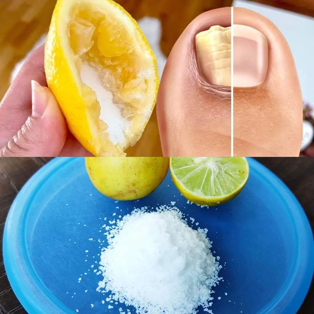 Nail Fungus Removal: 100% Natural Treatment for Toenail Fungus Using Lemon and Salt