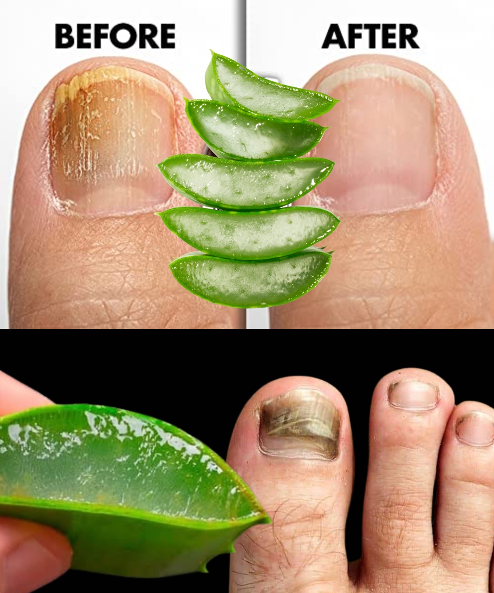 Kills nail fungus instantly! The best remedy! Benefits of Aloe Vera